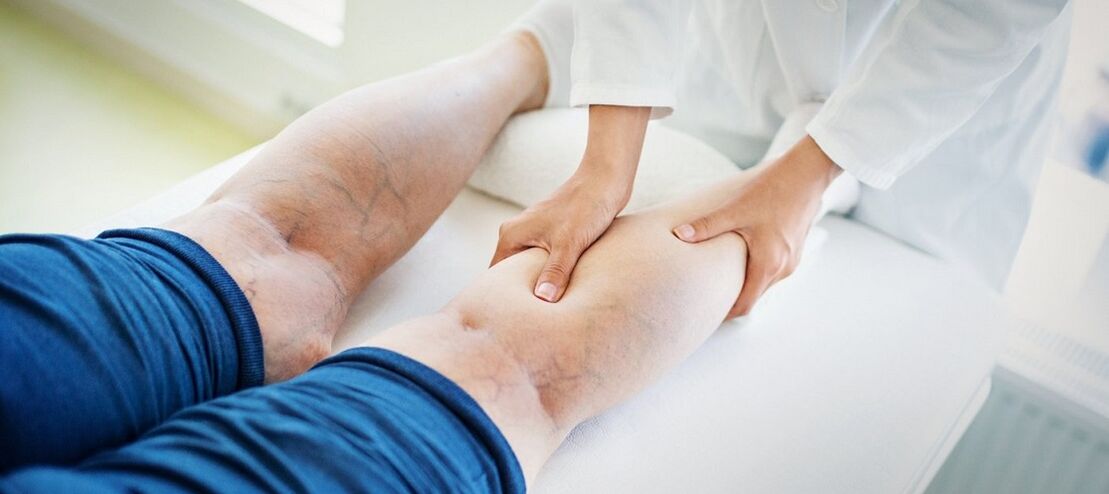 tratamentul venelor venice varicoase pe picioarele de medicamente varicoza barbai taiate